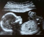 Shocking truth in Mandya 55 underage pregnant women scanned in a si...